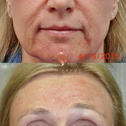 COMBINATION HALO & FILLER