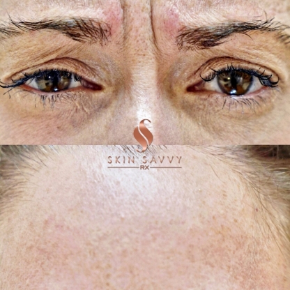 GLABELLA ("11" lines)