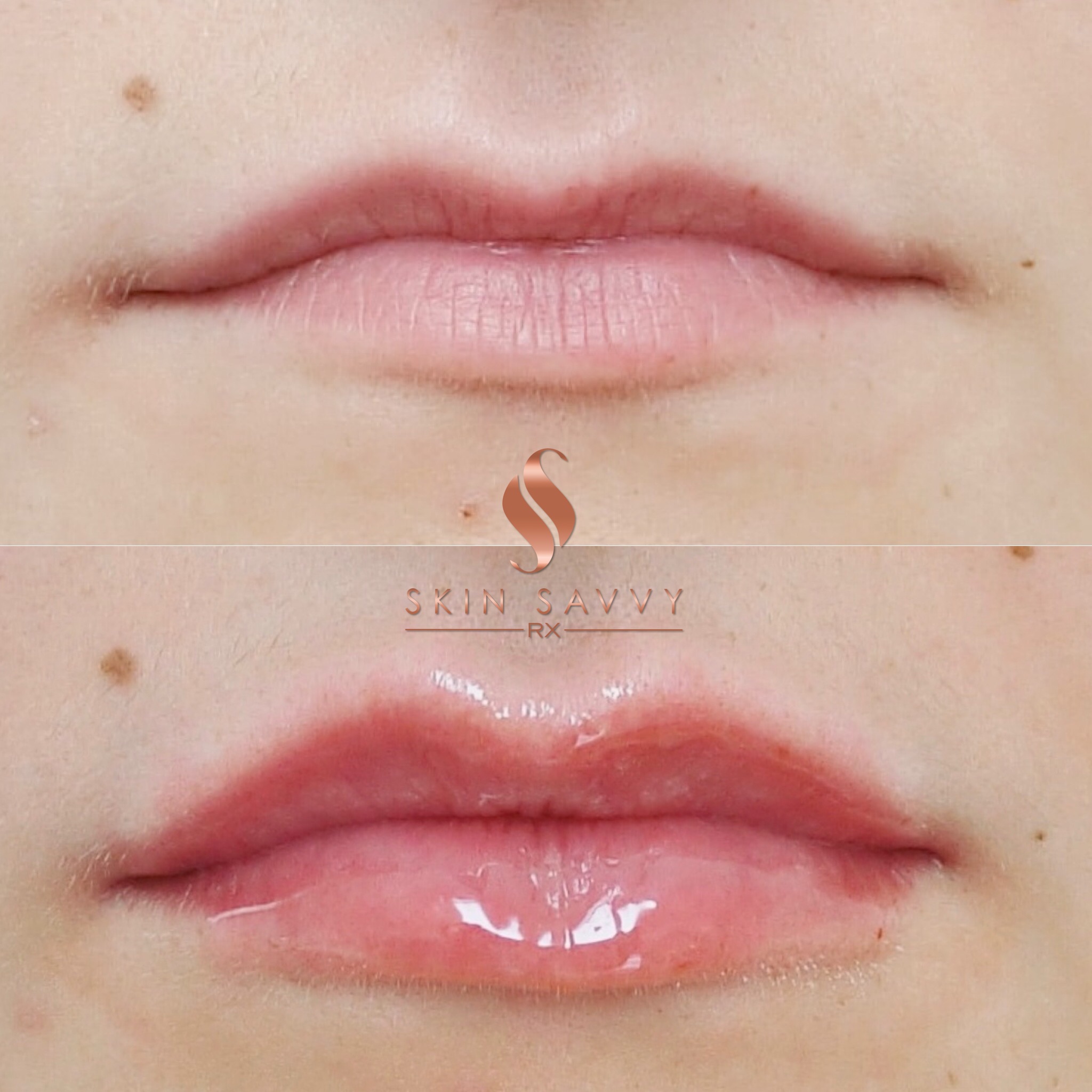 LIP AUGMENTATION