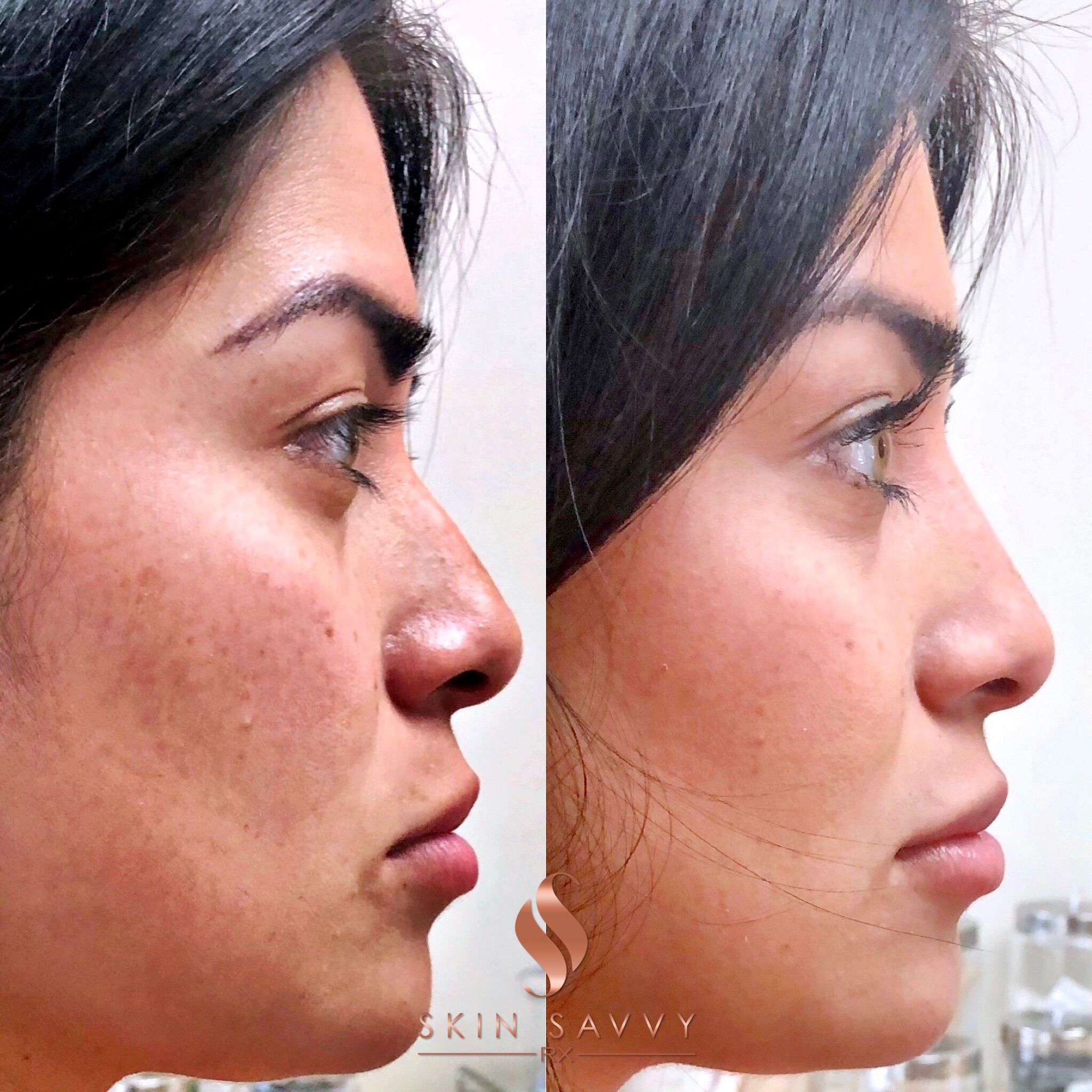 NONSURGICAL RHINOPLASTY