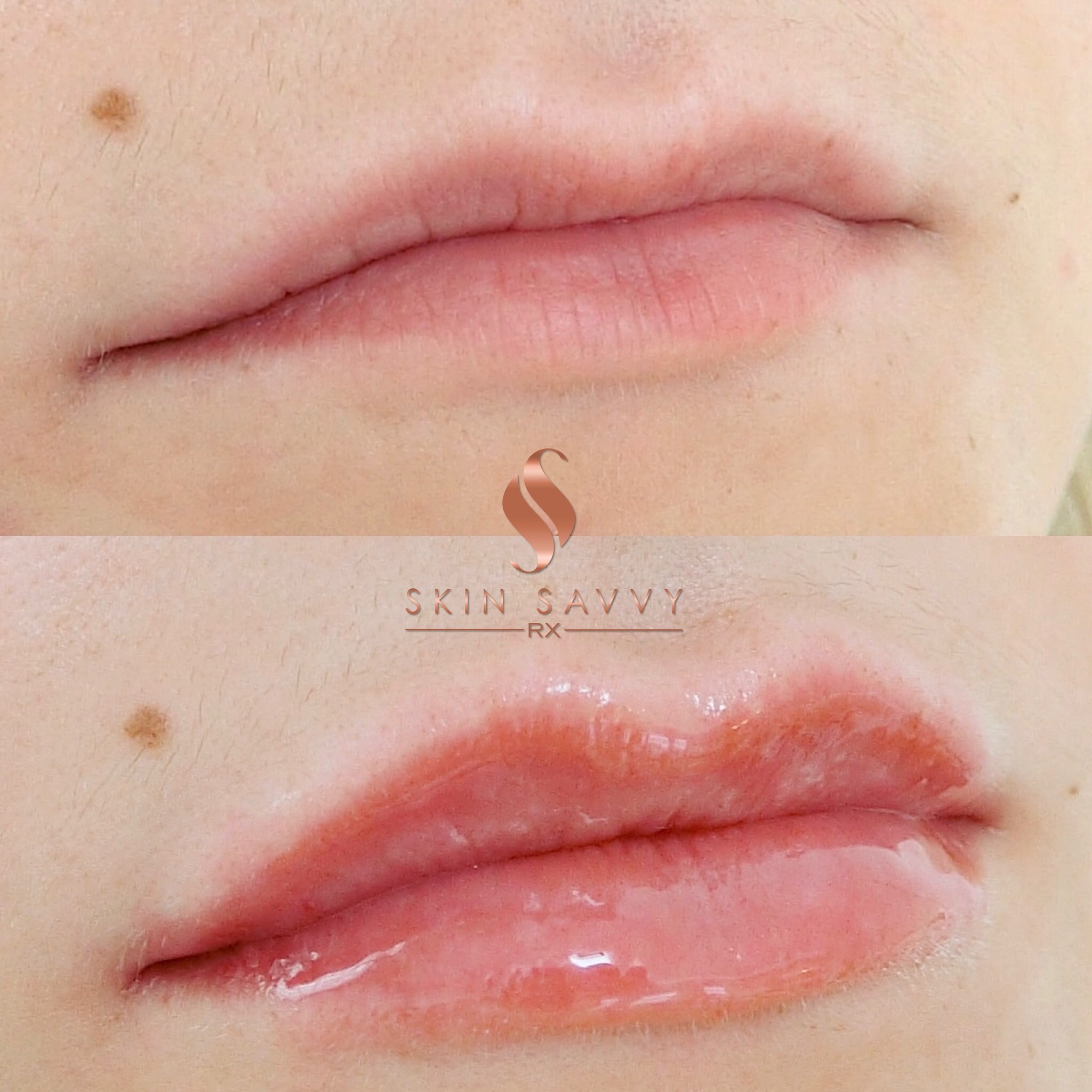 LIP AUGMENTATION