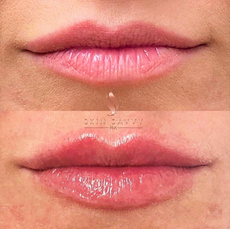 LIP AUGMENTATION