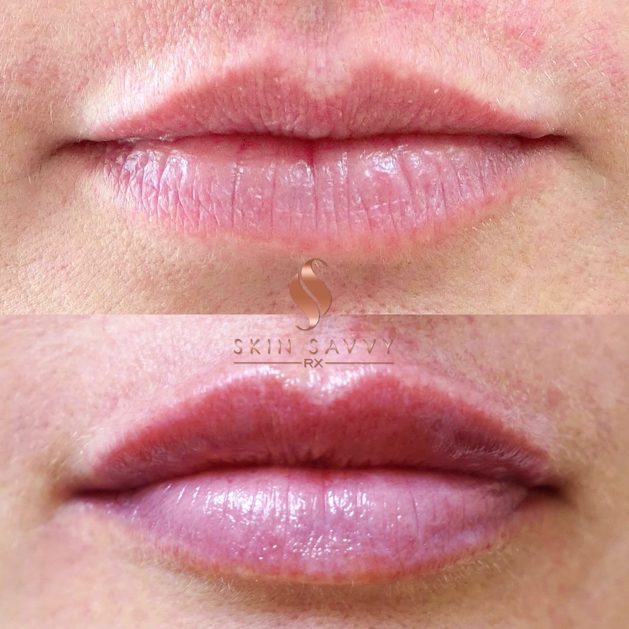 LIP AUGMENTATION